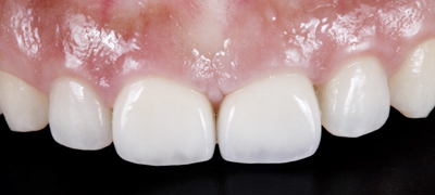 審美歯科症例 After