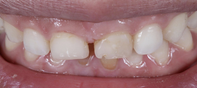 審美歯科症例 Before