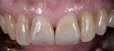 審美歯科症例 After