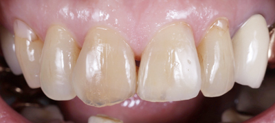 審美歯科症例 Before