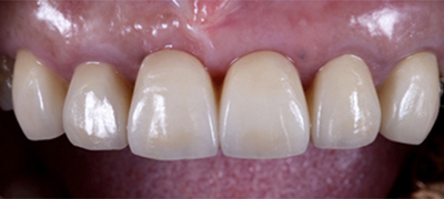 審美歯科症例 After