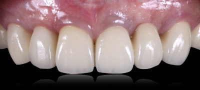 インプラント症例 After