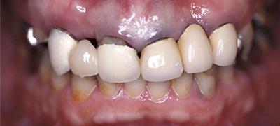 インプラント症例 Before