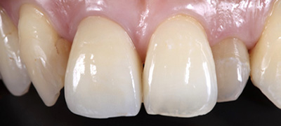 インプラント症例 After