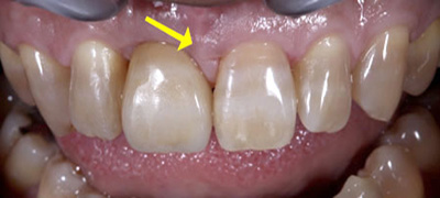 インプラント症例 After