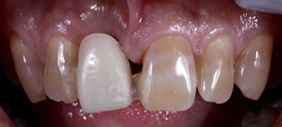 インプラント症例 Before